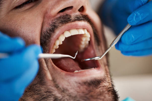 Best Emergency Dental Care for Sports Injuries in Mason City, IL