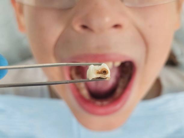 Best Emergency Root Canal Therapy in Mason City, IL