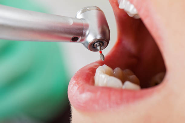 Best Emergency Wisdom Tooth Extraction in Mason City, IL